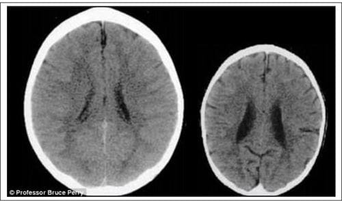 Images of a brain scan shared by Professor Bruce Perry that show how a neglected or abusive childhood can impact on the brain structures.